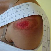 Abrasion of the shoulder (fall on roller skates): 1. day